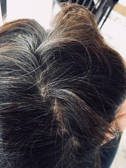 Hair regrowth after 7 months and it is not coming in grey, it's coming in her youthful color. 